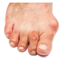 Bütyök (Hallux Valgus)